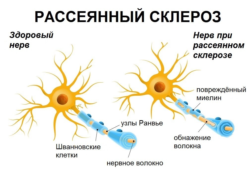 Рассеянный склероз картинки